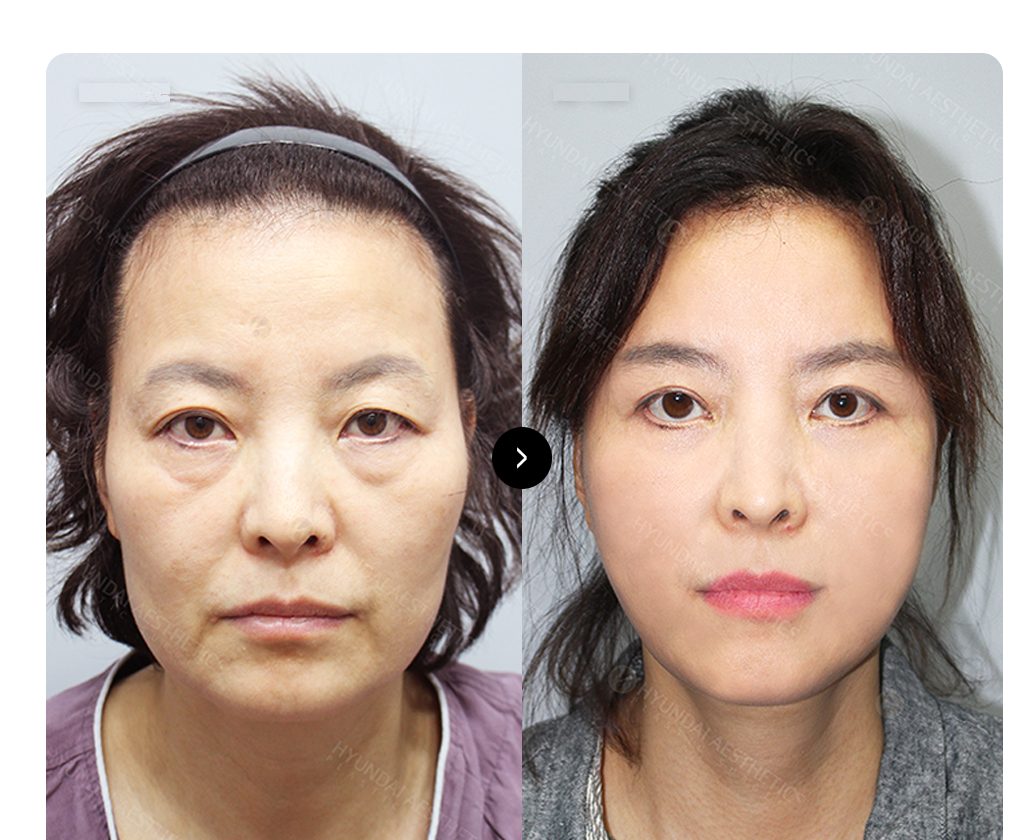SMAS การดึงหน้า BEFORE & AFTER — เปรียบเทียบก่อนและหลังการผ่าตัด