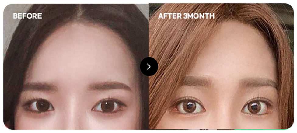 ก่อนและหลังยกหน้าผากเพื่อใบหน้าอ่อนเยาว์ 1