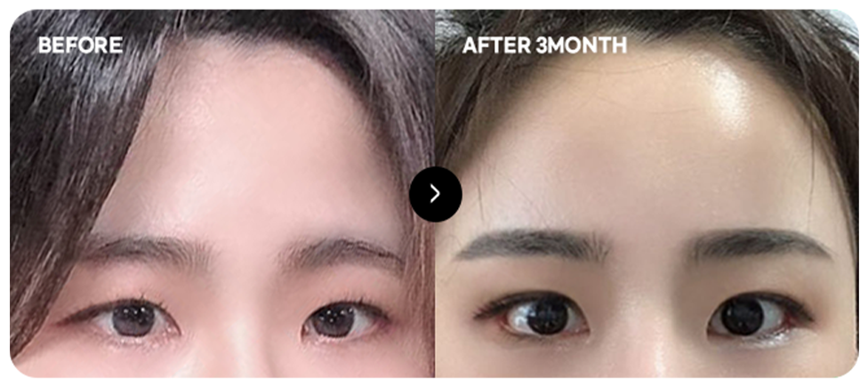 ก่อนและหลังยกหน้าผากเพื่อใบหน้าอ่อนเยาว์ 4