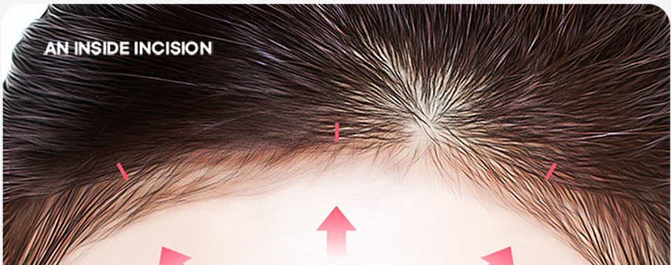 ภาพโคลสอัปหน้าผากที่แสดงตำแหน่งรอยกรีดด้านในไรผม — AN INSIDE INCISION