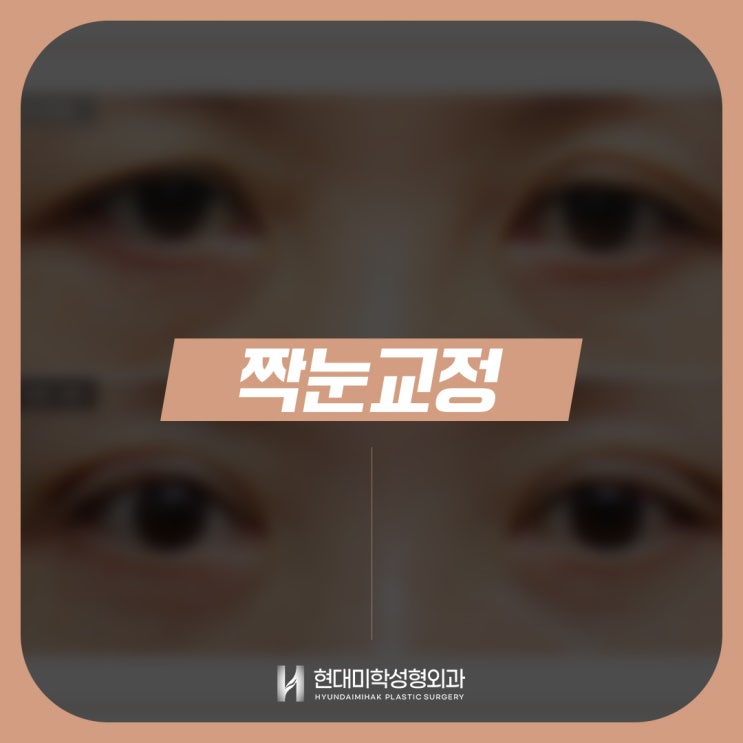 สิ่งสำคัญที่ควรรู้ควบคู่กับราคาการแก้ไขตาสองข้างไม่เท่ากัน