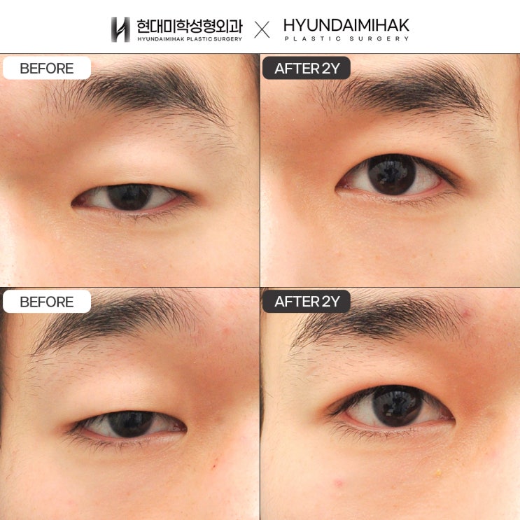 ศัลยกรรมตาผู้ชาย วิธีที่ชัดเจนที่สุดในการสร้างความประทับใจแรกที่โดดเด่น
