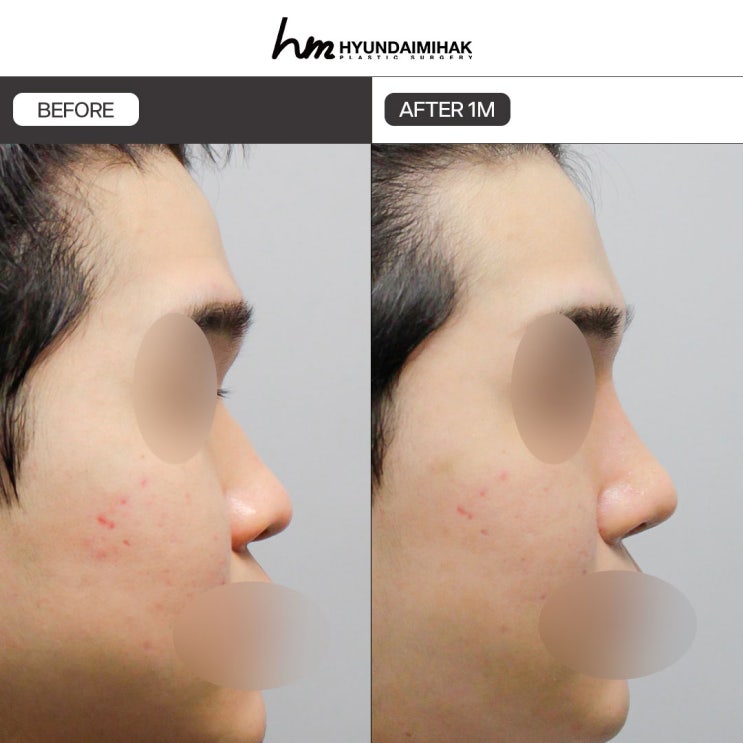 คลินิกศัลยกรรมจมูกผู้ชาย จุดเริ่มต้นของทางเลือกที่เปลี่ยนความประทับใจแรก