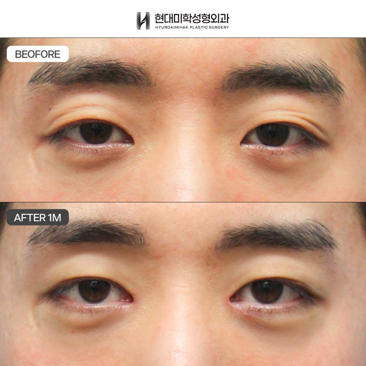 รีวิวแก้ไขกล้ามเนื้อตาในผู้ชาย หากต้องการความเปลี่ยนแปลงก่อนและหลังที่เห็นได้ชัด