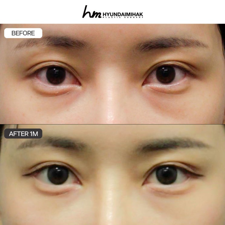 เงื่อนไขสู่ความสำเร็จของการเปิดหางตาแบบดูอัลโดยไม่เสียค่าใช้จ่ายเปล่า