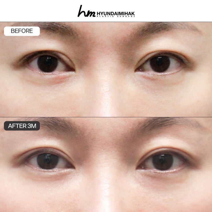 การผ่าตัดแก้ไขปรับกล้ามเนื้อตา คู่มือความปลอดภัยจากศัลยกรรมความงาม Hyundai
