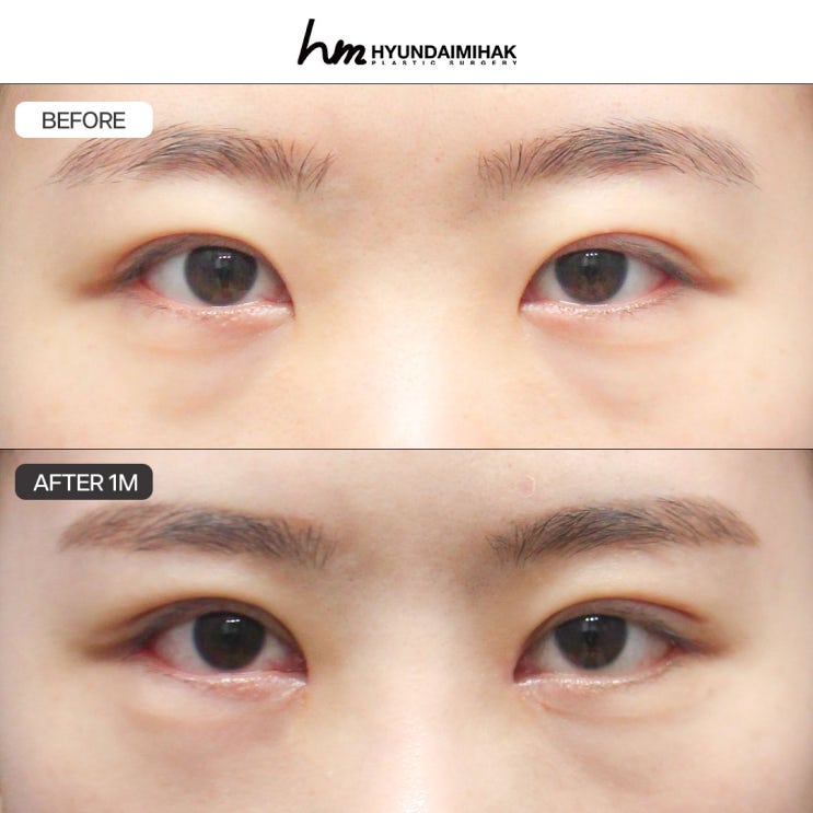 จุดสำคัญในการป้องกันความล้มเหลวของการแก้ตาที่คลินิกศัลยกรรม