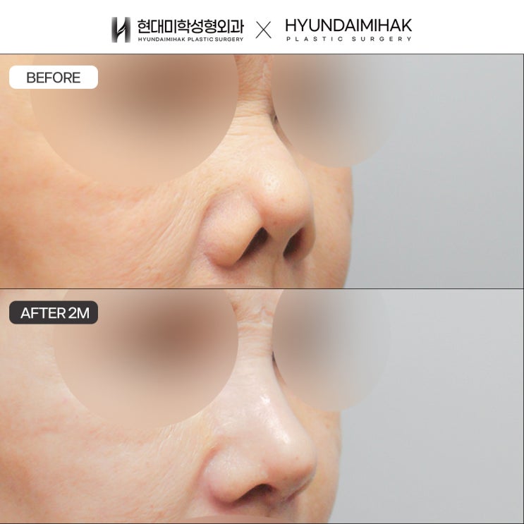 รีวิวแก้จมูกหดรั้ง อาจเกิดจากความผิดปกติของซิลิโคนหรือวัสดุเสริม