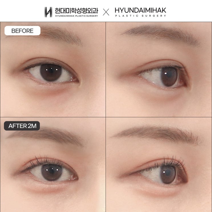 ทำอย่างไรจึงจะไม่ต้องเผชิญความล้มเหลวจากการผ่าตัดเปิดหัวตาซ้ำอีก