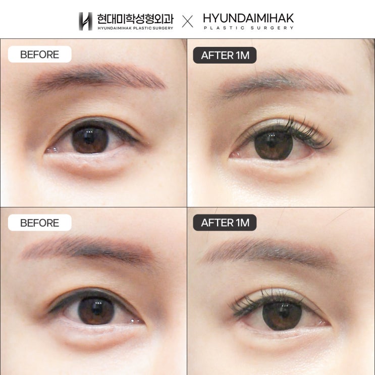 ศัลยกรรมเปิดหัวตาและหางตาเพื่อขยายความยาวของรูปตา