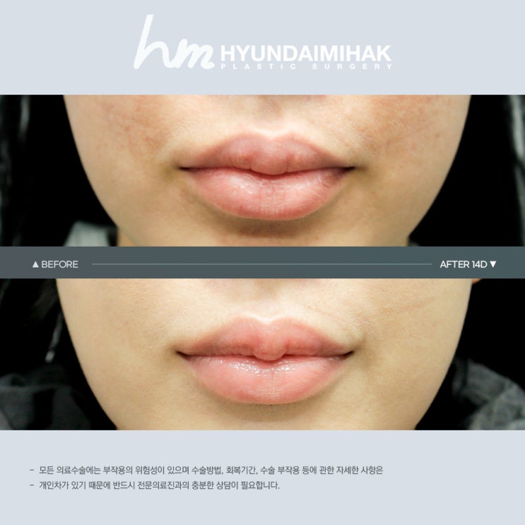 ศัลยกรรมรูปปาก เปลี่ยนบรรยากาศด้วยร่องใต้จมูกและมุมปาก