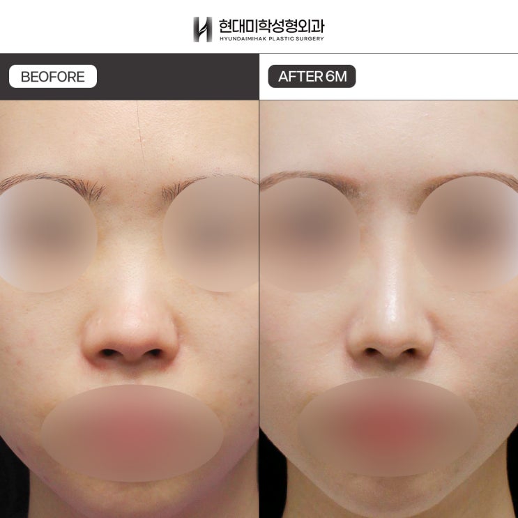 ค่าใช้จ่ายศัลยกรรมจมูกต่ำ ขึ้นอยู่กับวัสดุและรายการผ่าตัด
