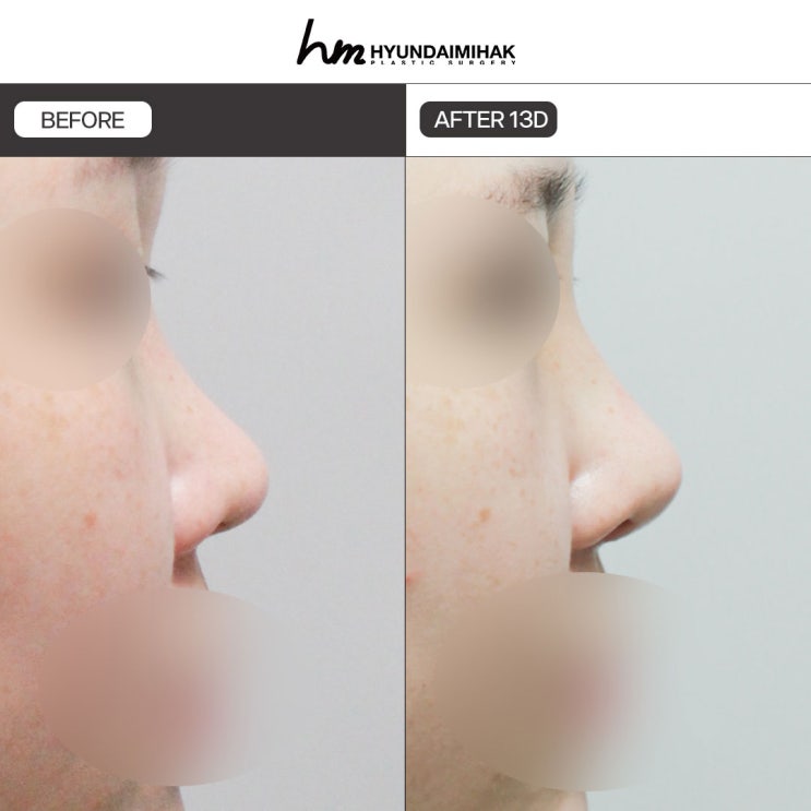ศัลยกรรมแก้จมูกสั้น เติมเต็มเส้นด้านข้างให้ดู refined