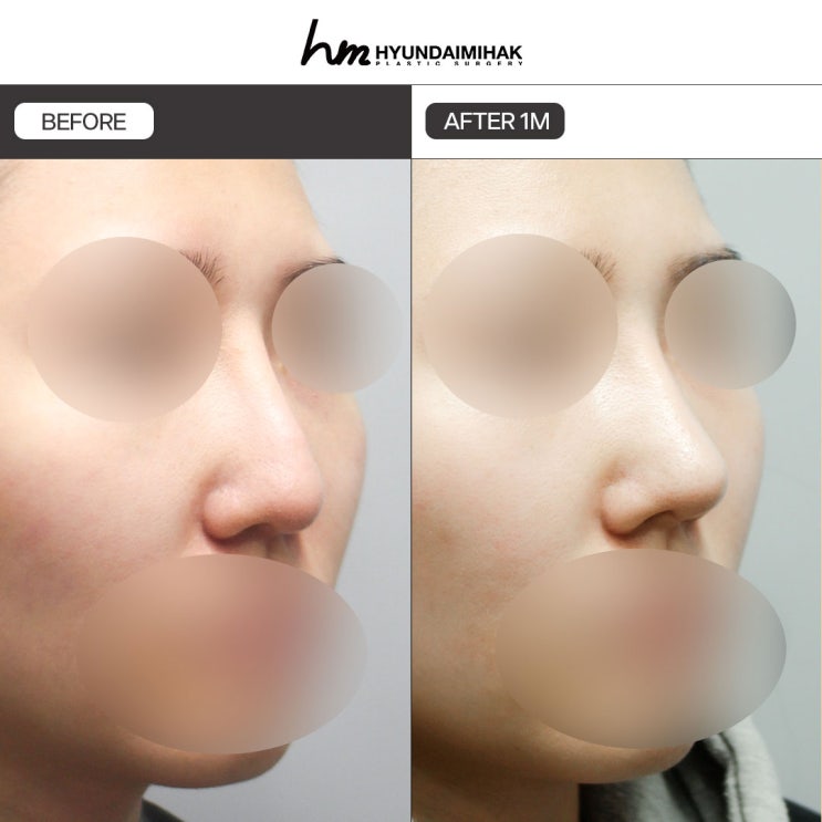 การผ่าตัดปรับมุมจมูกกับริมฝีปาก กุญแจสู่การปรับใบหน้าให้สมดุล