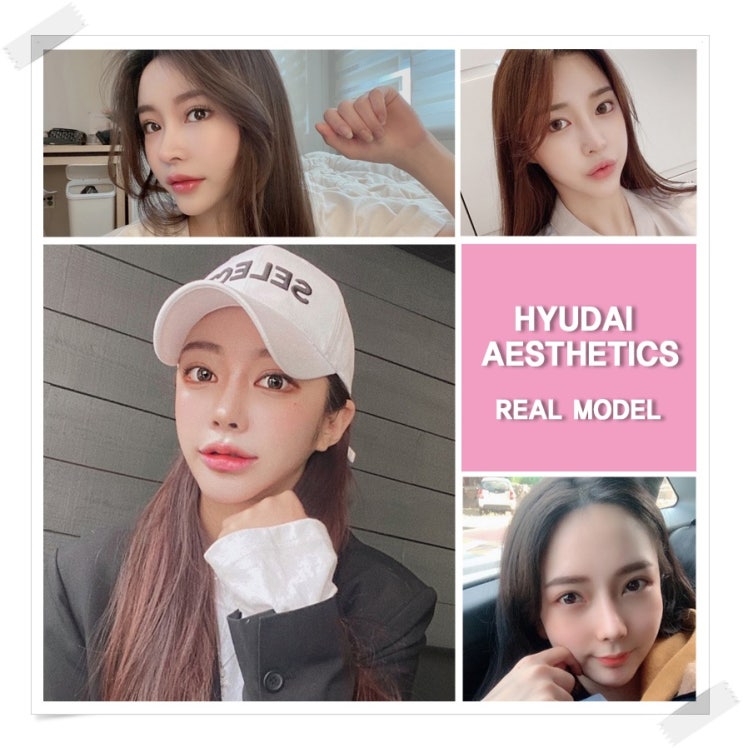 รีวิวศัลยกรรมตาสองชั้น เส้นชั้นตาที่มีเสน่ห์