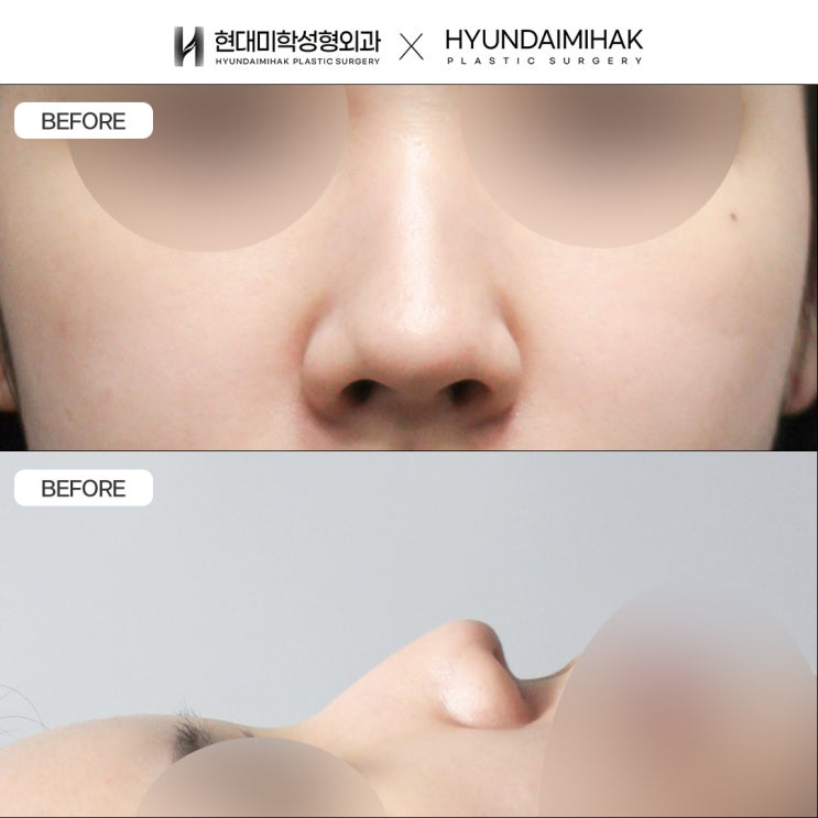 รีวิวศัลยกรรมแก้จมูกทรงลูกศร จมูกที่ปลายงุ้มลง