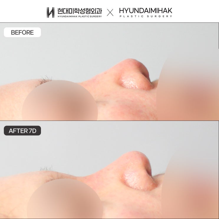 ศัลยกรรมแก้จมูกเชิด: ทางออกที่แม่นยำเพื่อความสมดุลของใบหน้า