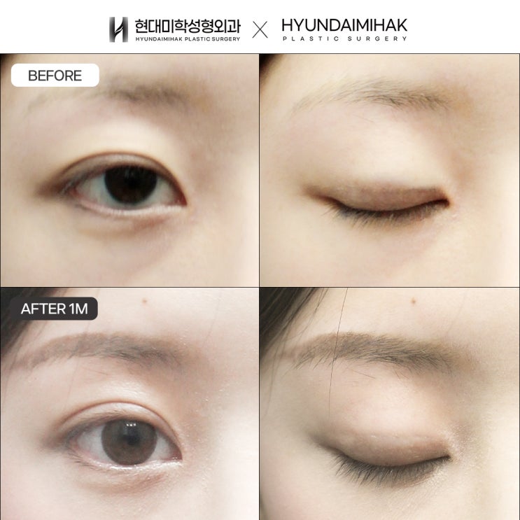 ฟื้นฟูรูปตาให้ดูเป็นธรรมชาติด้วยการตัดสินใจอย่างรอบคอบในการแก้ตาสองชั้นแบบกรีด