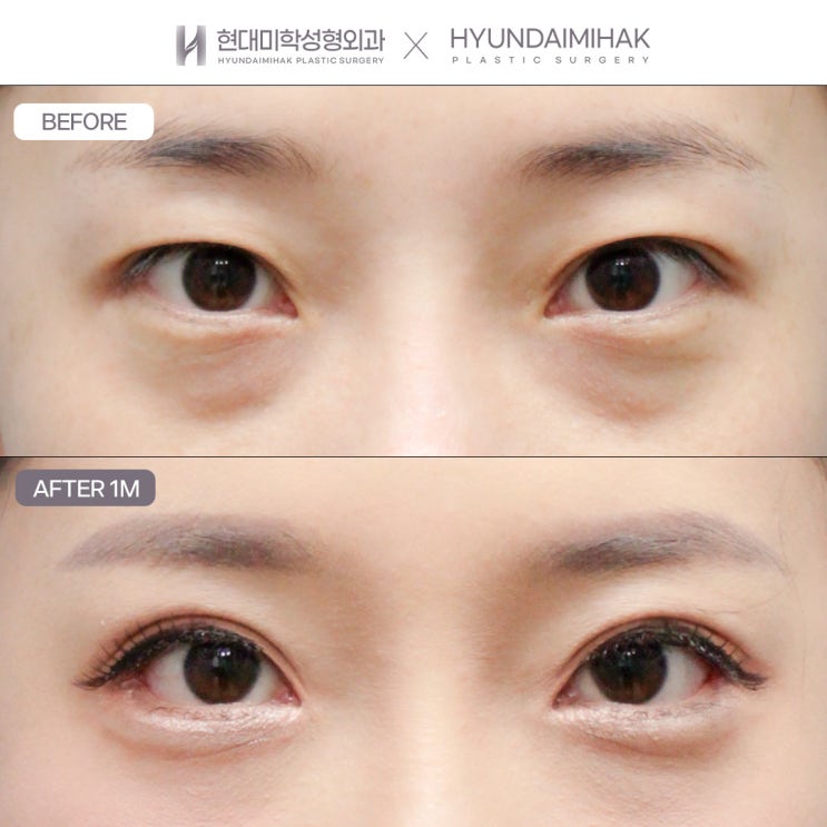 ทำความรู้จักกรณีที่เหมาะกับการเย็บตาสองชั้นแบบยึดติดธรรมชาติ