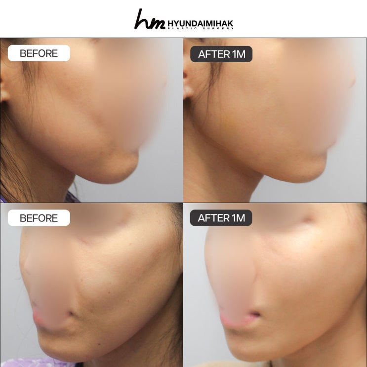 ราคาเฟซลิฟต์ ควรตรวจสอบเกณฑ์เหล่านี้ให้ชัดเจน