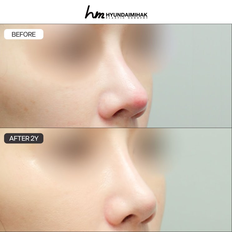 ซิลิโคนจมูกบางจนเห็นเป็นเงา เงื่อนไขของจมูกที่ปลอดภัยและสวยงาม