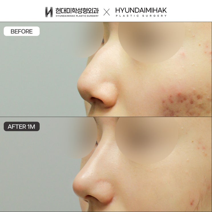 ศัลยกรรมแก้จมูกฮัมพ์ที่กังนัม เพื่อภาพลักษณ์ที่นุ่มนวลขึ้น