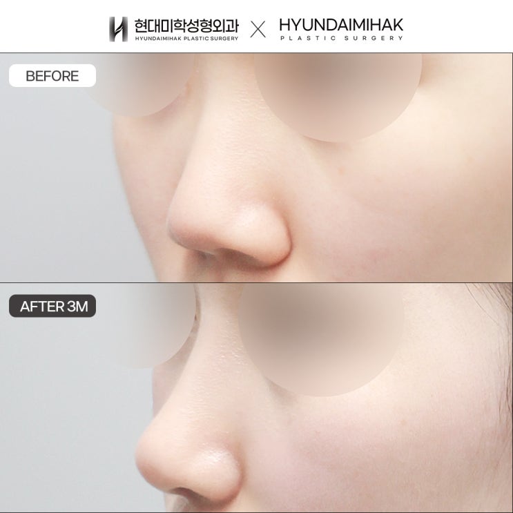 แนะนำคลินิกศัลยกรรมจมูก หลังสอบเข้ามหาวิทยาลัยจะดูแลภาพลักษณ์ให้มั่นใจได้อย่างไร