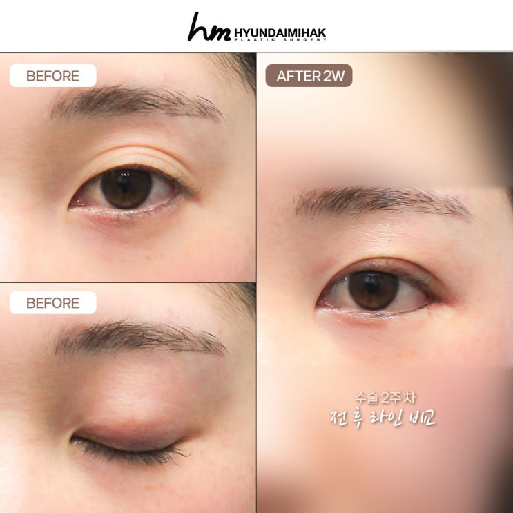 ตาสองชั้นแบบยึดติดธรรมชาติ สวยขึ้นโดยไม่ต้องกรีดที่ศัลยกรรมความงาม Hyundai