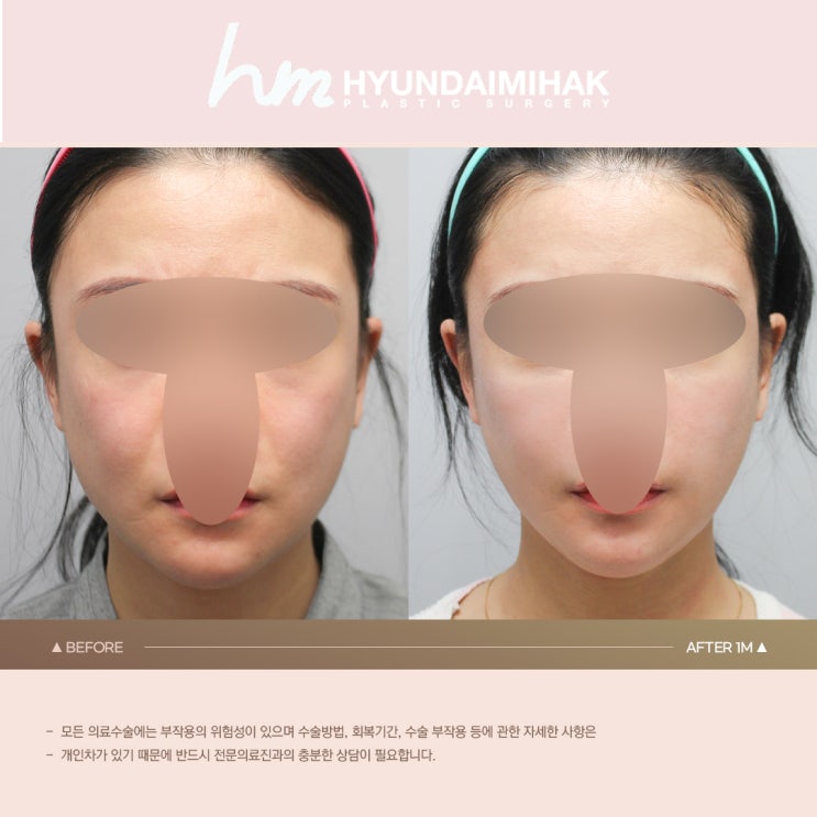 ศัลยกรรมความงาม Hyundai Q&A จริงเรื่องดูดไขมันใบหน้า│ต้องอ่านหากคุณสงสัยเรื่องดูดไขมันใบหน้า