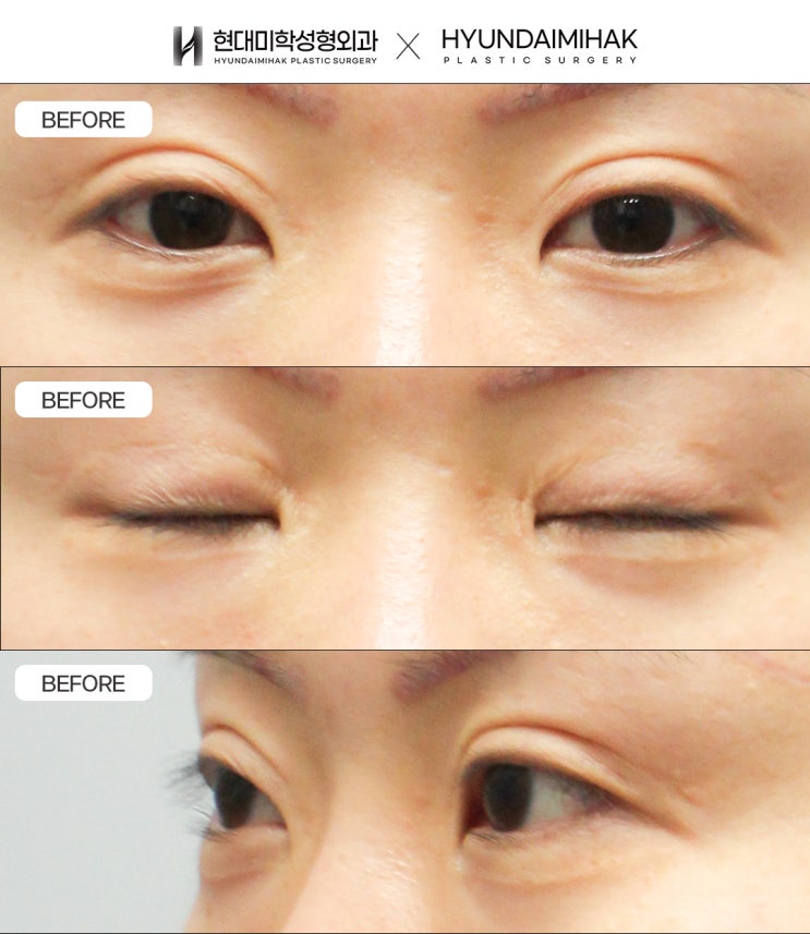 การผ่าตัดลดชั้นตาให้เหมาะกับปริมาณผิวหนังส่วนเกิน