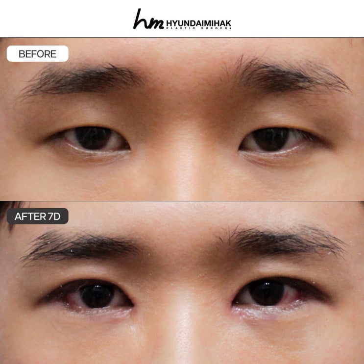ศัลยกรรมตาผู้ชาย ความเป็นธรรมชาติคือหัวใจสำคัญ