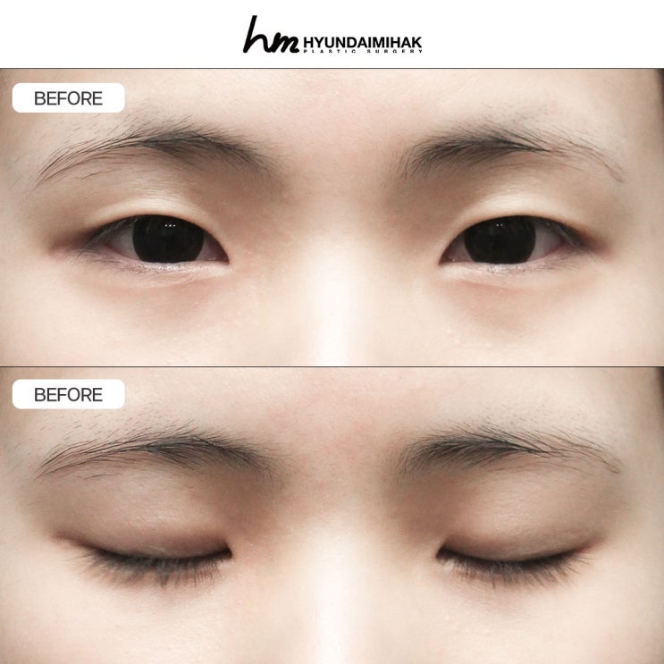 ศัลยกรรมตาสองชั้นแบบกรีด: การออกแบบที่เปลี่ยนแก่นแท้ของดวงตา｜สรุปครบทั้งวิธีผ่าตัด ความพึงพอใจ และการฟื้นตัว
