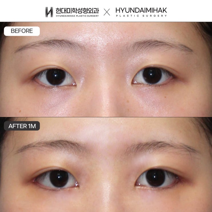 การผ่าตัดเปิดหางตาและปรับหางตาล่าง วิธีที่มีประสิทธิภาพและข้อควรระวังในการปรับรูปตา