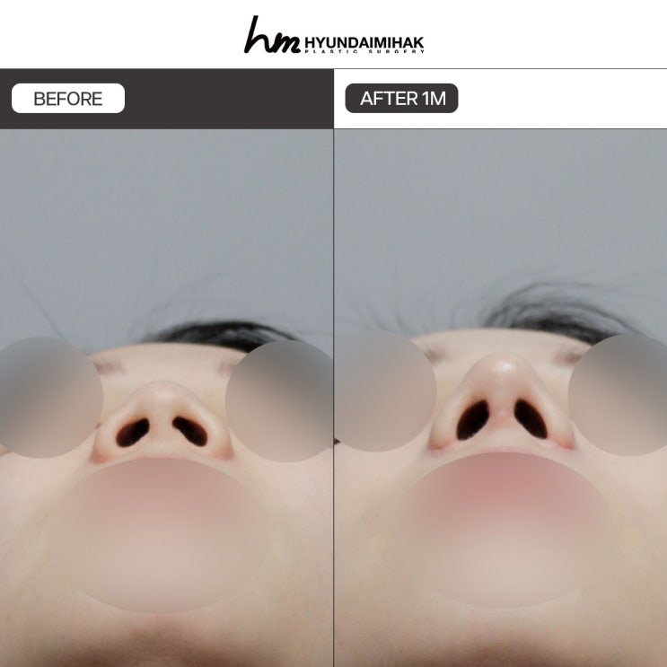 ศัลยกรรมแก้จมูกเชิด โซลูชันสำคัญในการเปลี่ยนภาพลักษณ์
