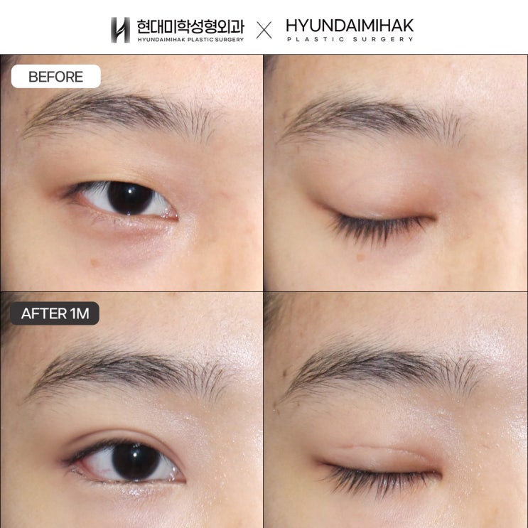 ตาสองชั้นแบบยึดติดธรรมชาติ ทางเลือกที่เหมาะที่สุดเพื่อดวงตาที่ดูเป็นธรรมชาติและคงรูป