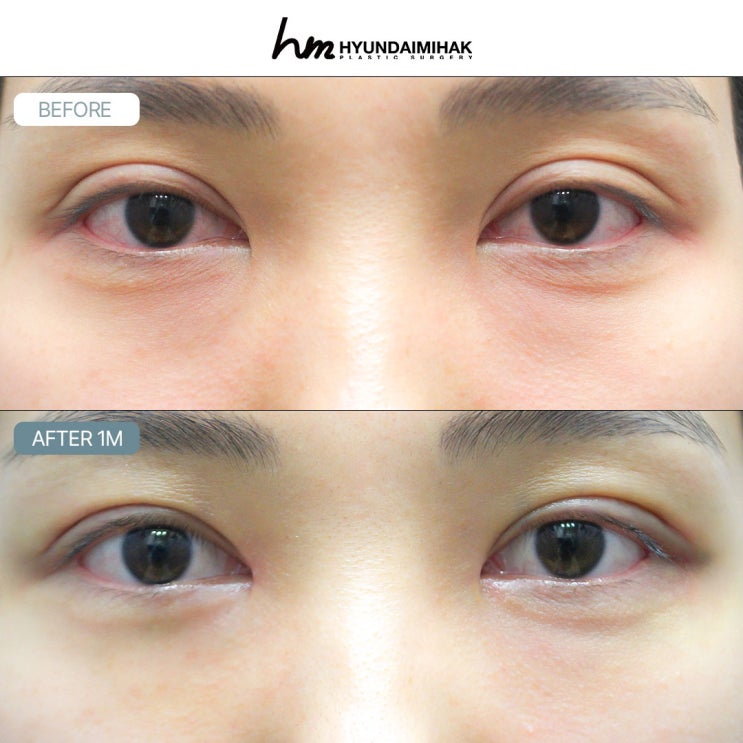รวมรีวิวศัลยกรรมแก้ตา จุดสำเร็จที่ศัลยกรรมความงาม Hyundai แนะนำ