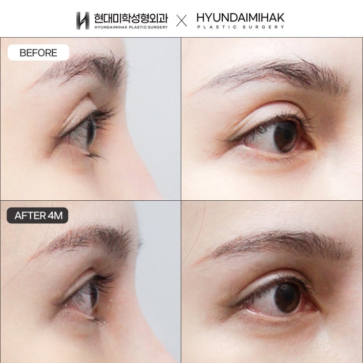 ทางออกที่เหมาะสมที่สุดสำหรับการแก้ตาสองชั้นแบบตาไส้กรอกโดยไม่ให้ล้มเหลว
