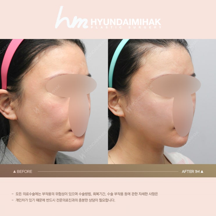 แนะนำการฉีดปรับกรอบหน้า หากต้องการจัดการไขมันบนใบหน้าและค้นหา V-line