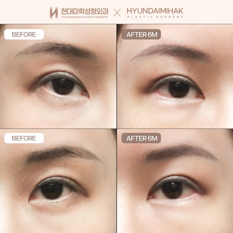 เปรียบเทียบรีวิวผ่าตัดเปิดหางตาและดึงขอบตาล่าง เพื่อออกแบบดวงตาที่สวยงาม