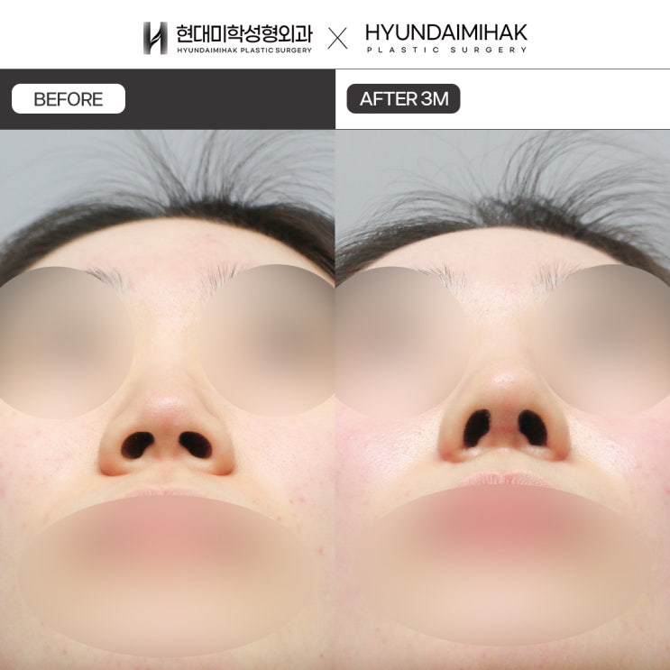 ลดปีกจมูกแบบไม่กรีด สำหรับจมูกที่ดูทู่และบาน