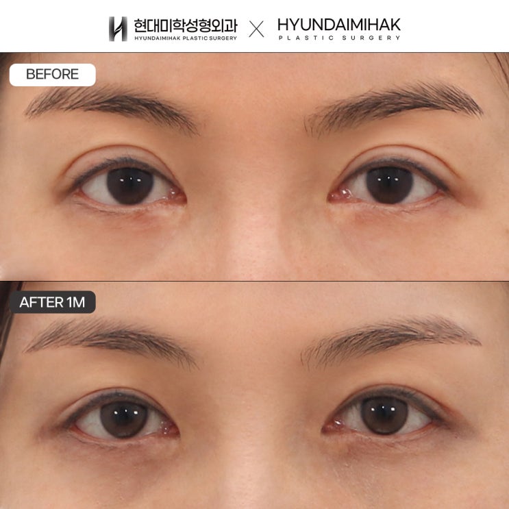 ปรับแก้ตาสองชั้นที่ไม่เป็นไปตามต้องการให้กลับมาดูเป็นธรรมชาติด้วยการผ่าตัดลดระดับชั้นตา