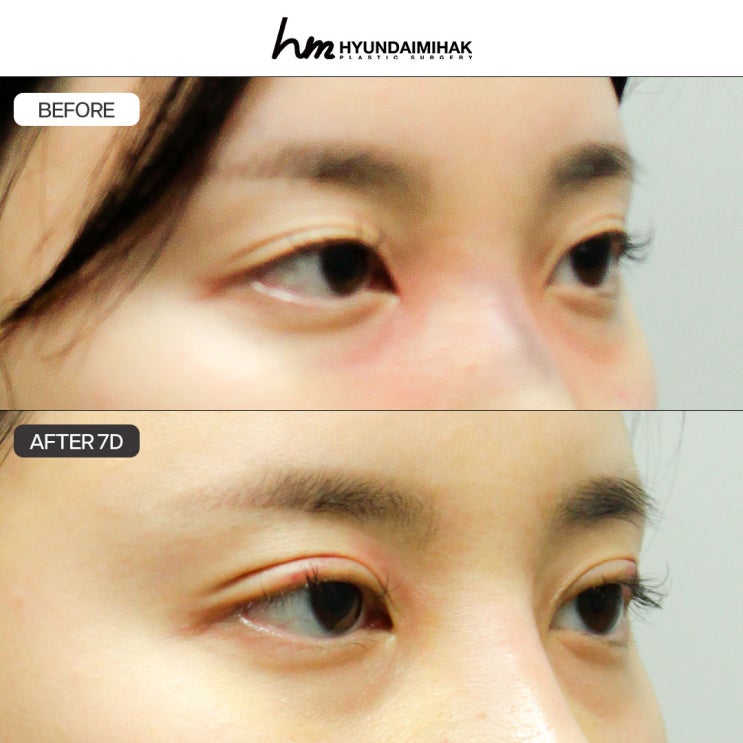 เหตุผลที่ศัลยกรรมความงาม Hyundai คือคำตอบในการเลือกคลินิกศัลยกรรมตาในกังนัม