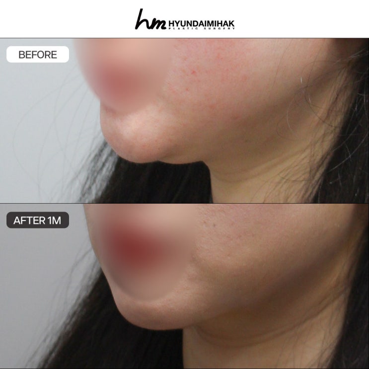 การเข้าใจการดูดไขมันเหนียงอย่างถูกต้องก่อนเข้ารับการรักษา คือกุญแจสู่ความสำเร็จ
