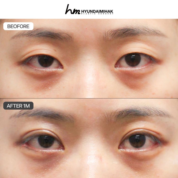 ศัลยกรรมปรับกล้ามเนื้อตา เปลี่ยนดวงตาให้ดูเป็นธรรมชาติและคมชัดยิ่งขึ้น