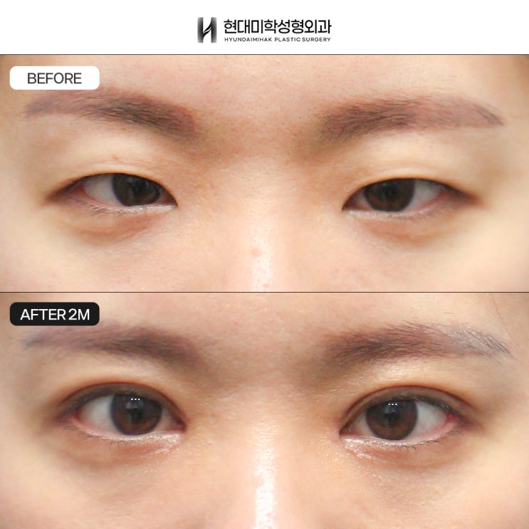 รีวิวทำตาสองชั้นแบบกรีด พร้อมปรับรูปตาไปด้วย