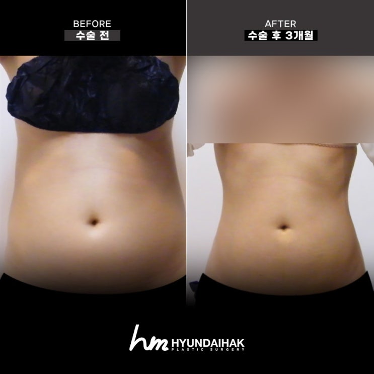 ราคาศัลยกรรมหน้าท้องที่สมเหตุสมผล พร้อมพิสูจน์ด้วยผลลัพธ์ ที่คลินิกศัลยกรรมบริเวณสถานีซินซา