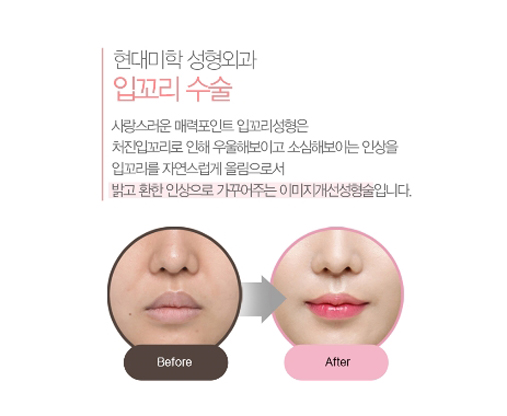 รีวิวศัลยกรรมมุมปาก ค้นพบรอยยิ้มสดใสที่ซ่อนอยู่