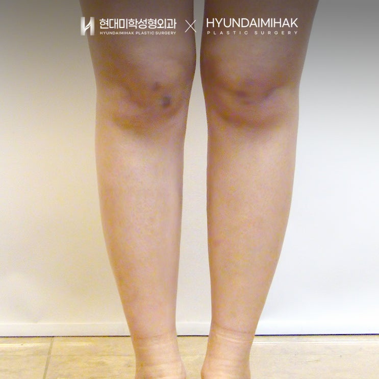 ปรับรูปร่างอย่างรวดเร็วและมีประสิทธิภาพด้วยมินิดูดไขมัน