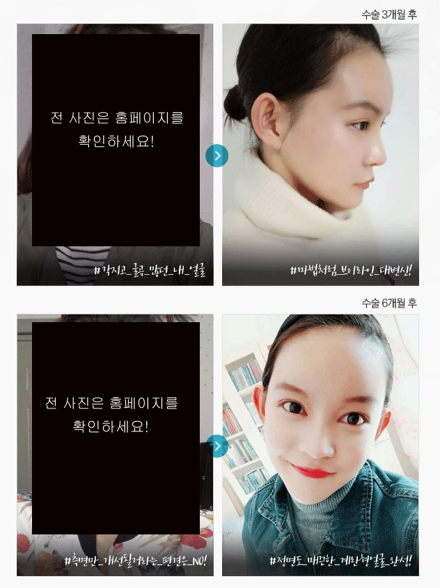 รีวิวศัลยกรรมปรับรูปหน้า บอกลาแอปแต่งรูป GOODBYE~
