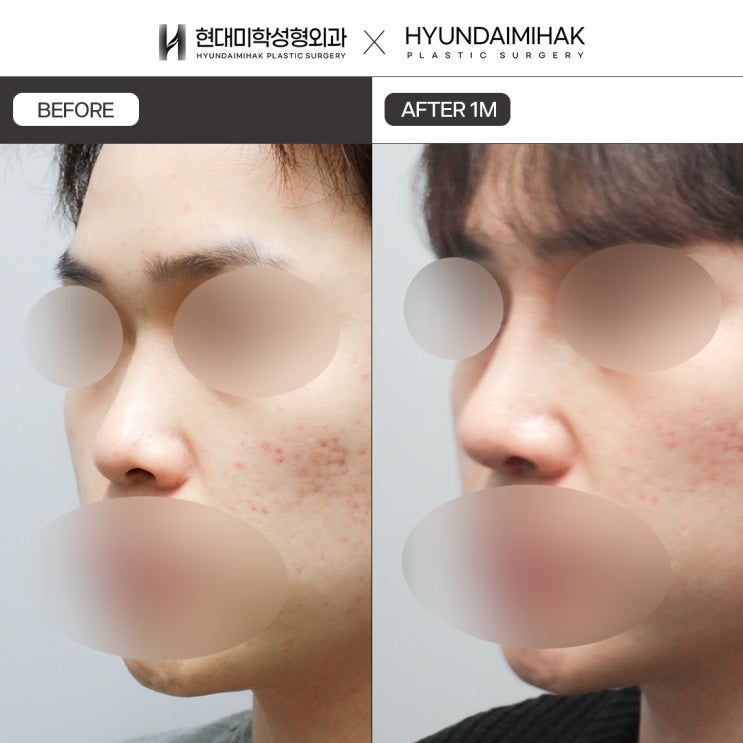 วิธีศัลยกรรมจมูกผู้ชายให้ดูเป็นธรรมชาติ